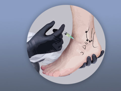 Prolotherapie